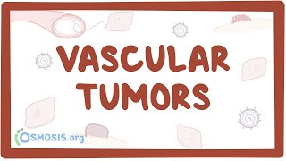 Vascular tumors kaposi hemangioma angiosarcoma  causes amp symptoms [upl. by Eltsyrk126]