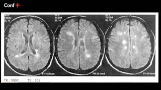 Cas dimagerie pathologie démyélinisante SEP ou ADEM [upl. by Elmer563]