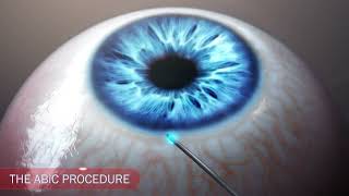 Ophthalmology glaucoma IOP drainage animation [upl. by Tap]