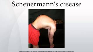 Scheuermanns disease [upl. by Monsour693]