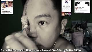 Ellowe Alviso  7th Day Ng Paglilinis ko Ng Sugat Sa Aking Ilong  Skin Grafting forhead [upl. by Akemor481]