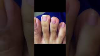 Ingrown toenail removal with Pedicure Knife Cut it easily Ep417 [upl. by Moreville]