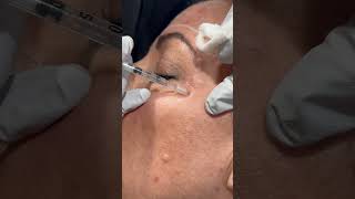 Botox for crow’s feet 10 units on each side botox aesthetics aestheticdoctor [upl. by Kerek186]