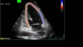 ABNORMAL STRAIN LONGITUDINAL ECHO [upl. by Nimrak]