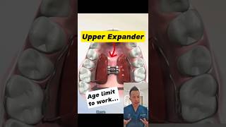 Best Age for Upper Expander Ideal Age Revealed dentallan dentist shorts [upl. by Aneehsat]