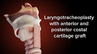 Medical Animation Anterior and Posterior Cricoid Split  Cincinnati Childrens [upl. by Aloeda]