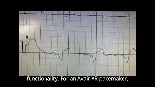 ECG after 6 months leadless pacemaker implantation Aveir VR [upl. by Johny]