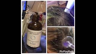 Can Ozone Therapy Really Regrow Hair [upl. by Khano46]