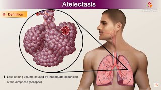 Atelectasis  Etiology Clinical Features Pathology pathophysiology Diagnosis and Treatment [upl. by Lyrak]