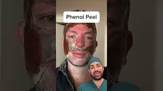 Phenol Peel skincare [upl. by Aihsi]