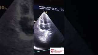 Constrictive pericarditis Echo  CP Echo  Echocardiography toacs  constrictive pericarditis [upl. by Stambaugh393]