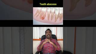 பல் வேர் சிகிச்சை  Root canals [upl. by Eanyl]