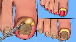 ASMR Cleanly Treat Old Ingrown Toenailsand Pus Toenails Scaling Animation Deep Clean Treatment [upl. by Anny941]