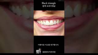 Diastema Closure by composite Resin앞니레진앞니블랙트라이앵글앞니벌어짐벌어진앞니blacktriangle [upl. by Rockafellow]