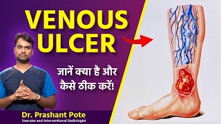 How to Identify and Treat Venous Ulcers at Home  Dr Prashant Pote [upl. by Aniret441]