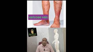 Varicose vein நரம்பு சுருட்டல்9092419061 [upl. by Gromme]