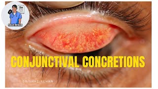 Conjunctival Concretions What are they Eye Dr Explains [upl. by Porte]