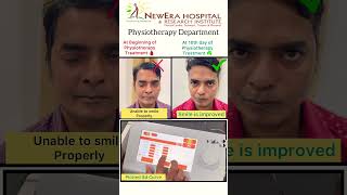 Physiotherapy results in Bells Palsy shorts [upl. by Atsirhc]