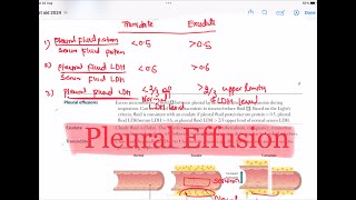 Pleural Effusion  Transudate Vs Exudate Respiratory 47  First Aid USMLE Step 1 in UrduHindi [upl. by Laen]