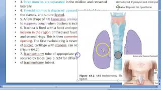 ENT Tracheostomy technique steps [upl. by Susan969]