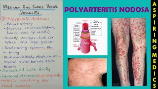 Polyarteritis nodosa pathology lectureVasculitis part 2 ASPIRING MEDICS [upl. by Otreblig]