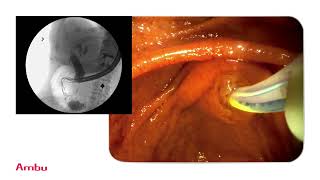 Dr Sam Serouya Performs amp Narrates a Sphincterotomy and Stent Placement Using the aScope™ Duodeno [upl. by Bremen]