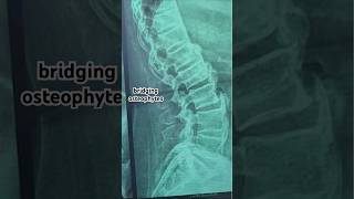 Ankylosing spondylitisBechtrewe’s diseaseAxial Spondyloarthritis xray video ultraradiology [upl. by Micaela]