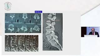 Osteoid Osteoma What Shall I Do by Dr Mohamed Fawzy Khattab [upl. by Lang831]