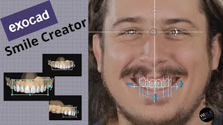 Exocad  Smile Creator [upl. by Ceevah]