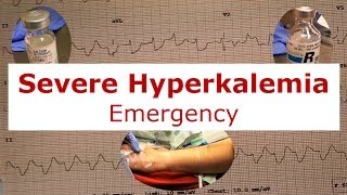 Severe Hyperkalemia Emergency [upl. by Yenolem368]