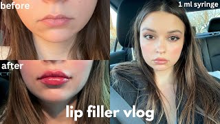 getting lip filler for the first time healing process before amp after results after 3 months [upl. by Lorain]