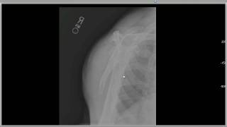 Normal Shoulder Radiography Take1 [upl. by Gebler16]