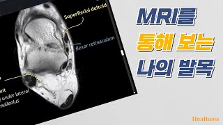 발목 ankle MRI 영상에서 확인해야 하는 인대 손상 어렵지 않아요 [upl. by Ayot]