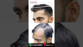 Incredible Advanced 3000 FUE Grafts Hair Transplant Results at Medispa Clinic By Dr Suneet Soni [upl. by Ulrikaumeko439]