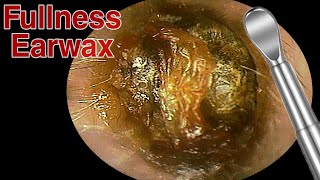 BIGGEST Ear Wax Difficult Removal  EP3  Doctor Anh [upl. by Comyns]