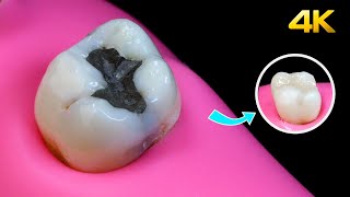 AMAZING Amalgam Filling Replacement [upl. by Tecil]