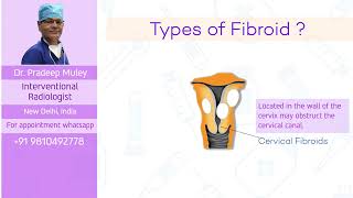 Symptoms of fibroids and various treatment options [upl. by Iorgo]