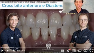 Ortodonzia con allineatori trasparenti Terza Classe Dentale prima dopo mascherine spazi tra i denti [upl. by Ocsisnarf]