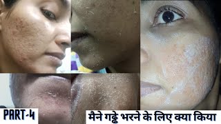 My Acne Scars Remove Part4 मैने गड्ढे भरने के लिए क्या किया  Acne Scars chicken pox scarsacne [upl. by Rebma]