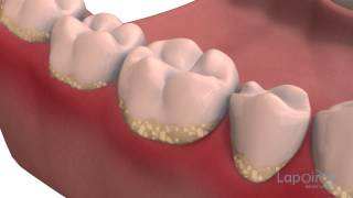 Decay formation  Lapointe dental centres [upl. by Tolland916]