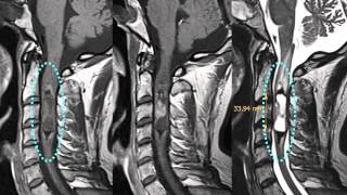 Spinal Masses  Location Intramedullary Ependymoma [upl. by Orat631]