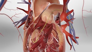 Pulmonary Artery Catheterization 3D Animation [upl. by Malinde]