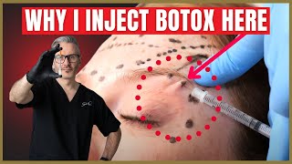 How To Inject Botox Under The Brow  Botox Brow Lift Advice [upl. by Anilegnave]