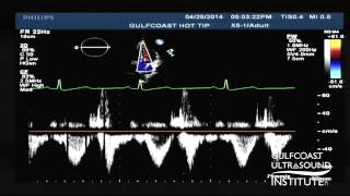 Hot Tips  Calculating the Aortic Valve Area Using the Continuity Equation [upl. by Atsillak]