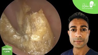 1278  x3 Ear Wax Removal Videos [upl. by Anile]