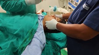 Extubation after surgery [upl. by Leakcim]