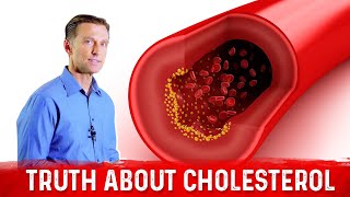 The Truth About Cholesterol – LDL Cholesterol amp HDL Cholesterol – DrBerg [upl. by Oigolue]