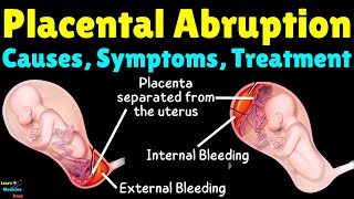 Placental Abruption Causes Symptoms Diagnosis Treatment Complications amp Prevention [upl. by Elfie]