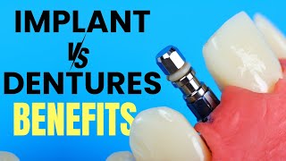 Fixed Dental Implants vs Removable Dentures Choosing the Right Option [upl. by Favian711]