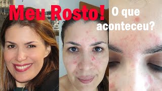 Dermatite seborreica rosácea ou alergia Como me curei da dermatite [upl. by Ihsar993]